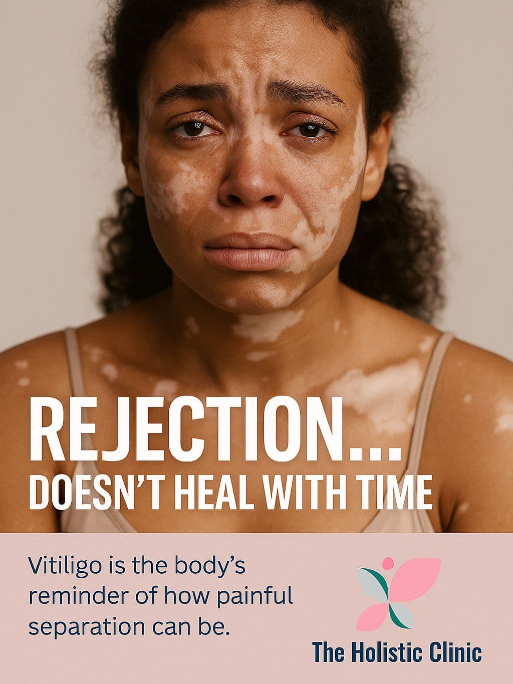 Vitiligo